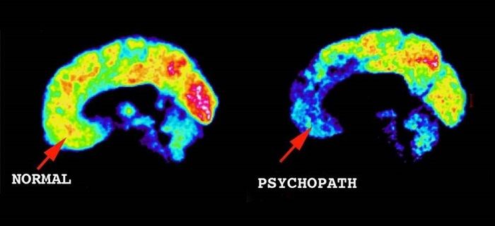 Psychopath Brain Scans Emotions